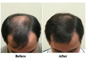 hair regrowth before and after for men